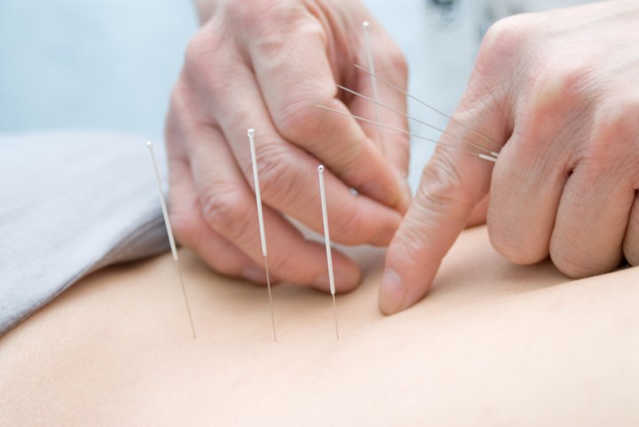 Acupuncture