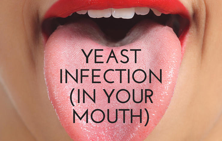 A Yeast Infection of the Mouth