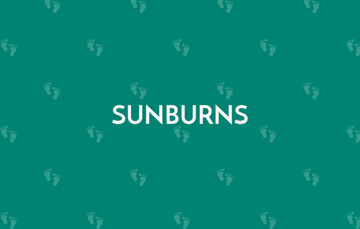 Sunburns